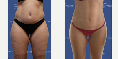 Woman treated with Vaser Liposuction, Renuvion - In total body shaping procedure with Vaserlipo, liposuction, bodyjet evo , Bodytite , Renuvion J Plasma or 1319 nm Laserlipolysis combination we can remove excess fat from both your upper and lower parts at the same time, we thin your legs, and thin your waist, we give the fat we take to your hips and the lines that make the body looks collapsed, and we uncover your contours curves.