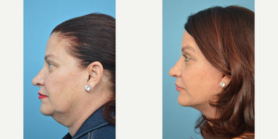 55-64 year old woman treated with Cheek Lift - This patient was concerned with the effects of aging along her neck and jawline. The after photo shows a significant improvement.