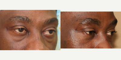 45-54 year old man treated with Eyelid Surgery - lower blepharoplasty