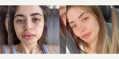 25-34 year old woman treated with Buccal Fat Removal - 25-34 year old woman treated with Buccal Fat Removal as well asFacial Fat Transfer, shown 3 months post op. Pre-op, patient felt sad because of the shape of her face and her prominent cheeks.