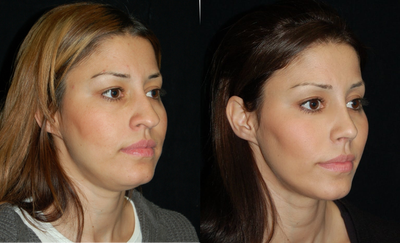 Cheek Fat Pad Removal - 26 year old female that underwent a buccal lipectomy, facial fat grafting, liposuction of the neck and rhinoplasty