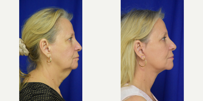 2926 65-74 year old woman treated with Facelift, Chin Liposuction, Double Eyelid Surgery, Brow Lift - 45-54 year old woman treated with Facelift, Neck Lift, Facial Fat Transfer, Eyelid Surgery