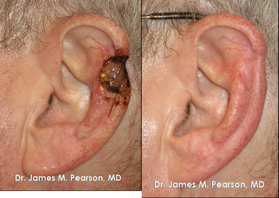 Ear Reconstruction / Mohs Reconstruction -
Ear Reconstruction / Mohs Reconstruction