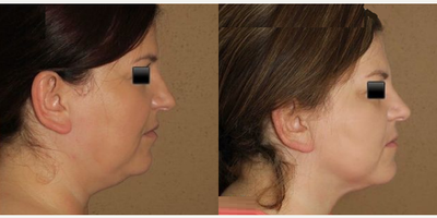 Woman treated with Liposuction - Here we did liposuction to remove excess submental ( neck) fat and used J plasma to tighten the skin