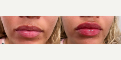 Woman treated with Juvederm - Woman treated with Juvederm XC as lip fillers