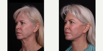 55-64 year old woman treated with Facelift, Deep Plane Facelift, Neck Lift, Eyelid Surgery, Facial Fat Transfer - Deep plane facelift, necklift, fat transfer, blepharoplasty B&A.