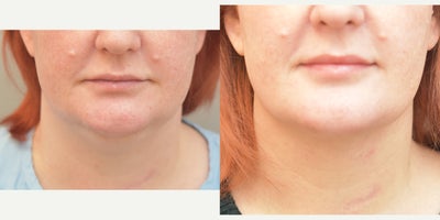 35-44 year old woman treated with Smart Lipo - Smartlipo neck
