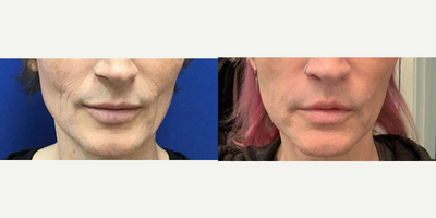 Patient treated with Juvederm - 1cc of Juvederm to Perioral Lines and Cheeks - 45 to 54 year-old female patient is 1 year post-op from Facial Feminization surgery. Her procedures included: 2 ccs Juvederm Voluma to Cheeks; Forehead Lift, Hairline Lowering, Orbital Bony Contouring; Thyroid Cartilage Shave; Mini Facelift; Subnasal Lip Lift with Fascia; Septorhinoplasty (closed) with Weirs, Soft Tissue Grafts and Cartilage Grafts; Voice Feminization; 1cc of Juvederm to Perioral Lines and Cheeks; 1 area Botox to Forehead and Botox 2 additional areas.