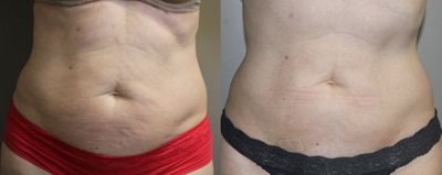 45-54 year old woman treated with SculpSure - Single treatment with four applicator heads: Two on right illiac fat pads and two on left illiac fat pads.