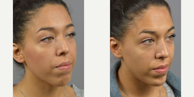Woman treated with Nonsurgical Nose Job, Botox, Dermal Fillers - Facial Asymmetry and contour is natural and makes each face unique. While most imperfections go unnoticed by the outside world. Often times we treat with surgical interventions but for a temporary adjustment with just as much impact the use of Botox and Filler can be used. Non-surgical Rhinoplasty by Dr. James Marotta complimented by filler injections to the chin.