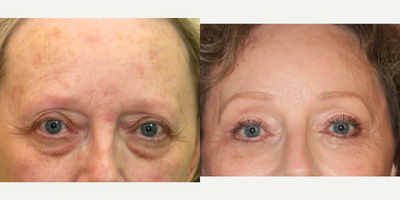 45-54 year old woman treated with Eyelid Surgery - Upper and Lower Blepharoplasty, Endoscopic Brow Lift and Laser Resurfacing Sciton Erbium/CO2