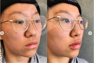 Woman treated with Lip Augmentation - Woman treated with Lip Augmentation