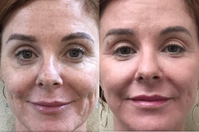 45-54 year old woman treated with Renuvion - Mini Facelift with renuvion subdermal and resurfacing