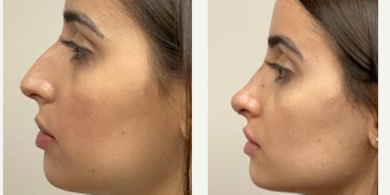 25-34 year old woman treated with Rhinoplasty - 8 days after a Rhinoplasty