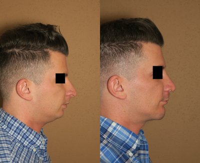 35-44 year old woman treated with Chin Implant - Rhinoplasty and Chin Augmentation
