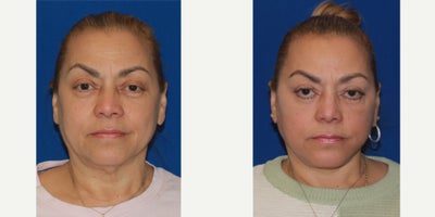 55-64 year old woman treated with Deep Plane Facelift, Neck Lift - 55-64 year old woman treated with Deep Plane Facelift, Neck Lift
