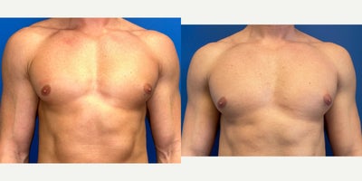 25-34 year old man treated with Gynecomastia excision, Liposuction chest - 32-year-old male (5'10, 170 lbs) achieves a flatter, more masculine chest contour following bilateral gynecomastia surgery. For this patient, direct excision to eliminate glandular tissue beneath the areola was performed. This correction restores a firm, defined pectoral appearance and eliminates the cone-like protrusion or excess volume that can affect clothing fit and self-confidence. The result is a natural, athletic chest profile with minimal scarring that aligns with the patient's fit physique.