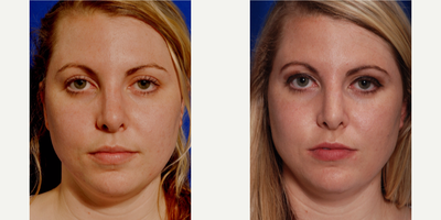 25-34 year old woman treated with Non Surgical Nose Job - Liquid Rhinoplasty to correct depression of the upper third of the nose. HA filler was used to create a balanced and straight appearance