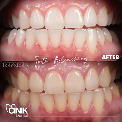 25-34 year old man treated with Teeth Whitening - Teeth Whitening