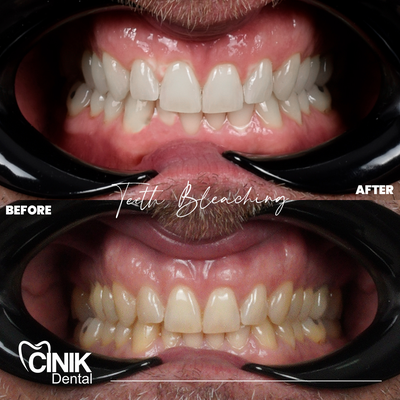 25-34 year old man treated with Teeth Whitening - Teeth Whitening