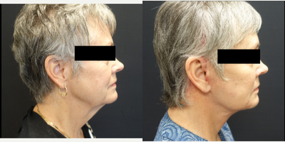 55-64 year old woman treated with Face and Neck lift with facial fat grafting. - Patient underwent a high lateral SMAS face and neck lift with platysma band plication and facial fat grafting. The combination of all these techniques give her a dramatic difference in her neck while still maintaining a natural appearance to the face overall. The fat grafting restores the volume that patients lose over time as they age. The combination of the fat transfer and facelift give patients a more natural and youthful appearance.