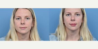 25-34 year old woman treated with Restylane - This patient was concerned with the lack of volume to her lips. She was treated with Restylane Kysse to add volume.