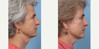 65-74 year old woman treated with Deep Plane Facelift, Brow Lift, Eyelid Surgery - 3 months post op