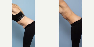 35-44 year old woman treated with Breast Implant Removal, Breast Lift, Mini Tummy Tuck - 38 year old3 childrenRemoval of 4 year old progressive Motiva Demi 300/285cc implants6 weeks & 6 months post opExplant + mastopexy + mini abdominoplasty