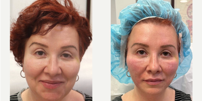 45-54 year old woman treated with Thread Lift - Witness the magic of Dr. GolBerg's non-surgical facelift, which combines PDO threads, PRF, and other bio-stimulating materials to contour the face with minima downtime and long lasting results.