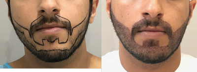 25-34 year old man treated with Beard Transplant - FUE Beard Transplant 10 days after