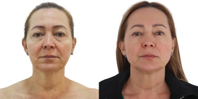 45-54 year old woman treated with Ultherapy - This is a non invasive treatment with microfocused ultrasound technology and visualization. Helps achieve a fresher, more youthful look from the eyebrows to the cleavage. Improves skin appearance. Generates skin retraction. Optimize collagen production. Improves tone and texture. Oxygenates and provides hydration to the treated areas.