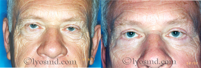 Upper and Lower Blepharoplasty - Facelift - 68-year-old gentleman before and after facial rejuventaion with upper and lower eyelid-lift (blepharoplasty)
