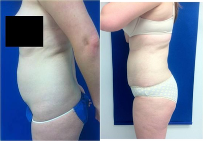 Laser Liposuction -
Laser Liposuction