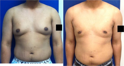 Laser Liposuction -
Laser Liposuction