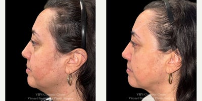 45-54 year old woman treated with CoolPeel, CO2 Laser - This 45-54 year old female patient underwent two CoolPeel CO Laser Skin Resurfacing treatments to improve overall skin texture and tone. Her results show smoother, more even skin with reduced fine lines and redness, revealing a refreshed and healthier-looking complexion with little to no downtime.