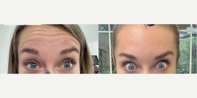 Woman treated with Botox - Woman treated with Botox.