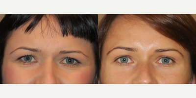 35-44 year old woman treated with Eyelid Surgery - upper blepharoplasty