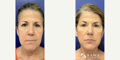 Woman treated with Silhouette InstaLift - Woman treated with Silhouette Soft