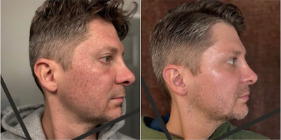Man treated with CO2 Laser, Laser Resurfacing - The same results in 1 session compared to less intense lasers that take multiple sessions. Treats facial scarring. acne scarring, fine lines & wrinkles, and more!