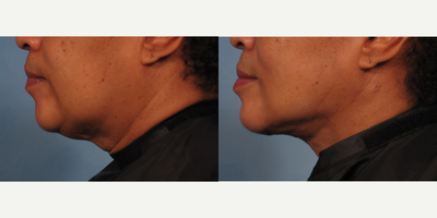 55-64 year old woman treated with Neck Lift (Precision Tx Laser Neck Lift) - This woman wanted tightening of the neck skin without major surgery. She had Precision Tx laser neck lift.