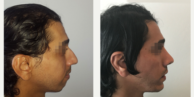 35-44 year old man treated with Chin Implant - Chin implant Surgery performed by zge Ergn, MD (1 year post op.)