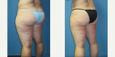 45-54 year old woman treated with Liposuction - Dr. Johnson performed Smartlipo on this patient to slim and smooth her thighs. The pictures are pre-op and 4 months post-op