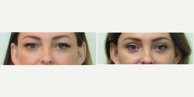 Mid-30 year old woman with upper eyelid lift/blepharoplasty - This young woman presented to our Center with the concerns of excessively heavy upper eyelids. She had attempted botox numerous times and did not get the lift that she was hoping for. She also had resorted to dramatic and full artificial eyelashes in order to hide and cover her upper eyelid fullness.During consultation we decided to perform an upper blepharoplasty treatment in our Center.Under local anesthesia with mild oral sedation with xanax, the excess skin was removed over both eyelids with the placement of ultra-small stitches. The patient only took tylenol the evening after the procedure and the sutures were removed 5 full days afterwards.Her results show re-establishment of the eyelids she enjoyed when she was in her 20s. She chose to not use heavy lashes since she was happy to see her eyelids again. She also stated that eyeshadow and mascara placement was much easier due to having much less skin covering her lids.