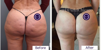 Woman treated with Aveli - Woman treated with Aveli, shown 2 months post op.