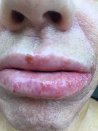 Fever Blister On Lip The Most Effective Method To Get Rid Of Fever