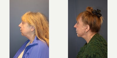 Woman treated with Facelift, Neck Lift - Woman treated with Facelift, Neck Lift