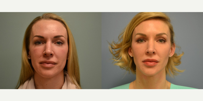 35-44 year old woman treated with Voluma - Patient had a Rhinoplasty and Voluma