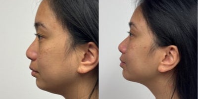 35-44 year old woman treated with Kybella - 3 weeks after a Rhinoplasty