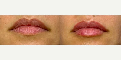 35-44 year old woman treated with SkinVive - Lip results after injecting 1 syringe of SkinVive