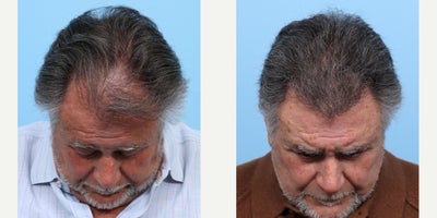 75 and up year old man treated with FUE Hair Transplant, Hair Transplant, Hair Loss Treatment, PRP Injections, PRP for Hair Loss - To restore this patient's hairline and add density, Dr. Wise performed an FUE hair transplant along with one treatment of PRP.